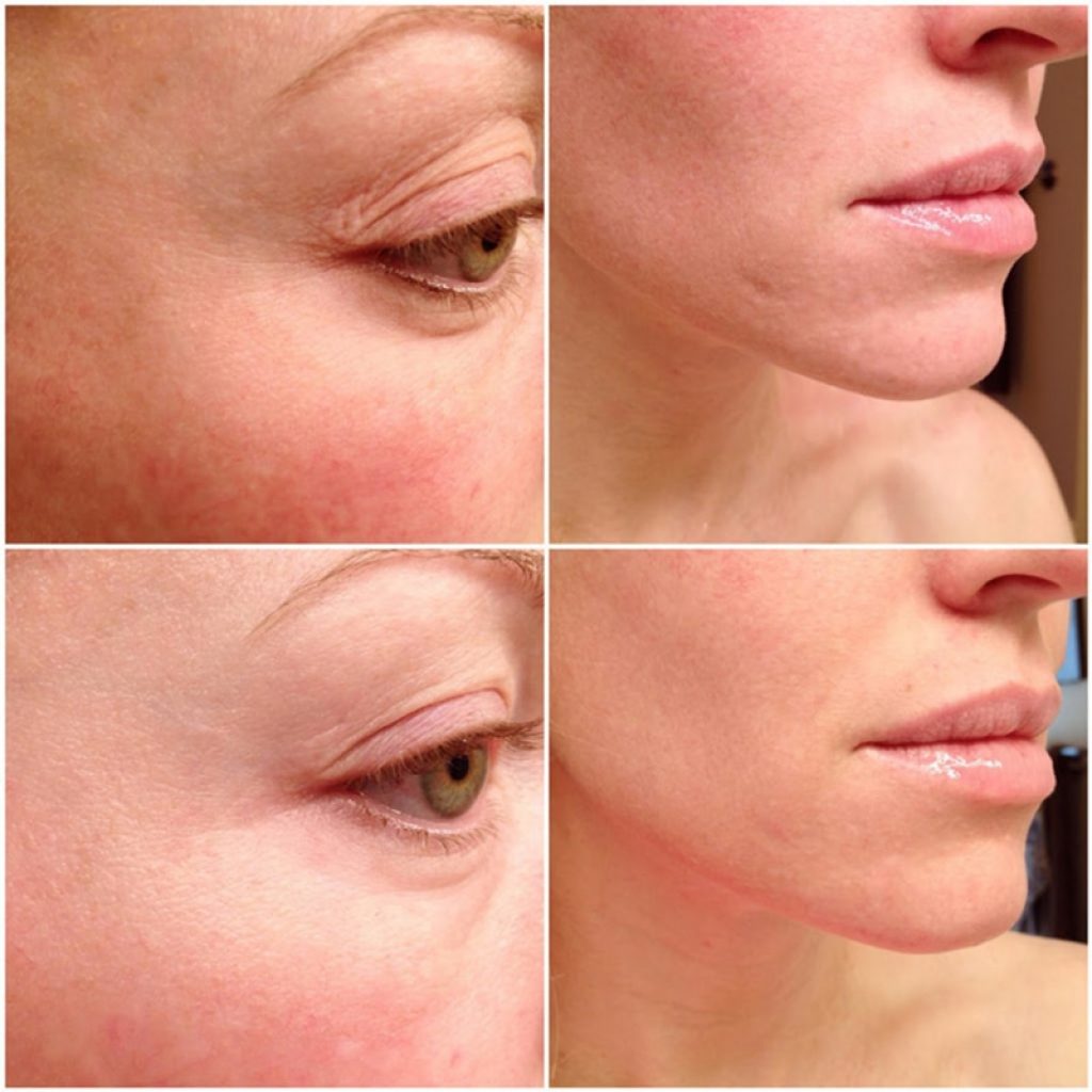 The Ordinary AHA 30 BHA 2 Peeling Solution Concealer Makeup Face Hyaluronic Acid Serum Anti Aging 5
