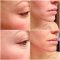 The Ordinary AHA 30% BHA 2% Peeling Solution Concealer Makeup Face Hyaluronic Acid Serum Anti Aging Whitening Skin Care